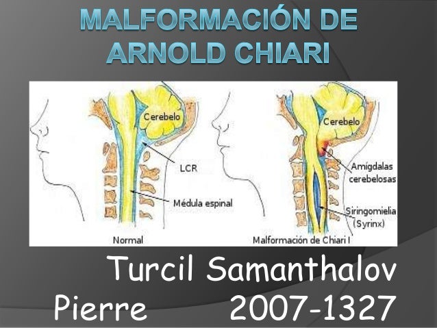 sindrome de arnold chiari